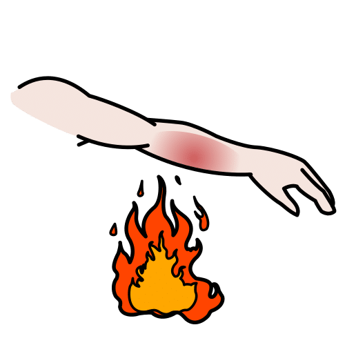 burn