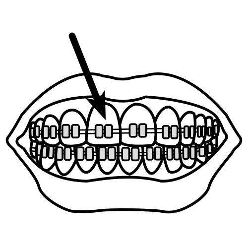 dental apparatus, brace, brackets