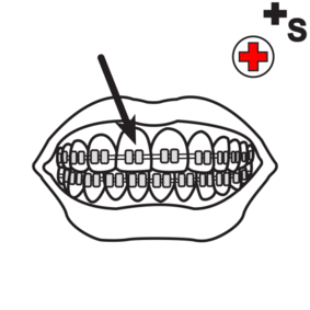 braces, brackets