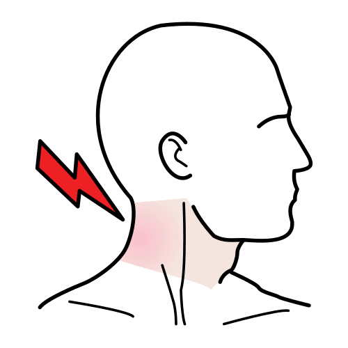 Torticollis