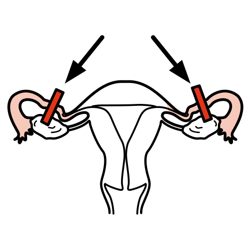 привързване на маточните тръби