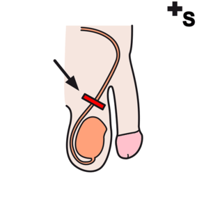 vasectomie, sterilisatie