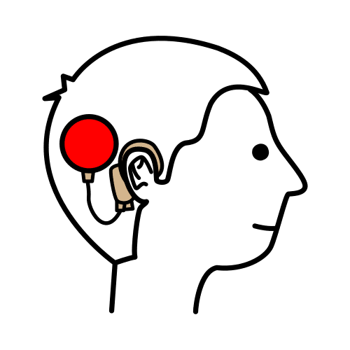 cochlear implant