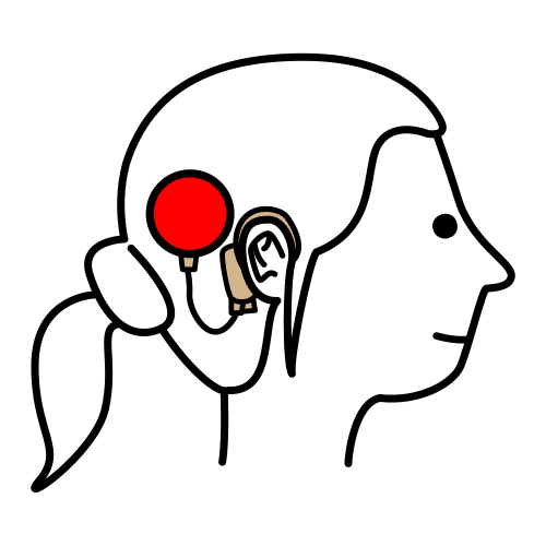 cochlear implant