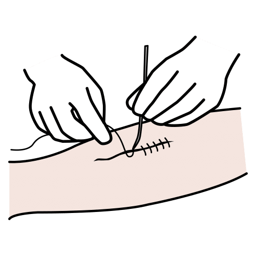 suture