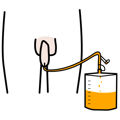 foley catheter