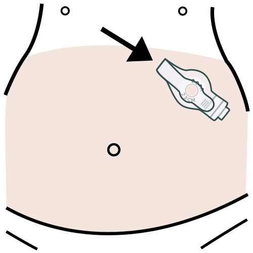 gastrostomy button