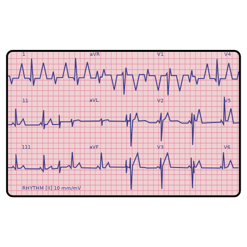 electrocardiogram