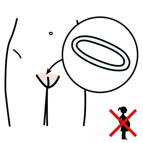 vaginal ring