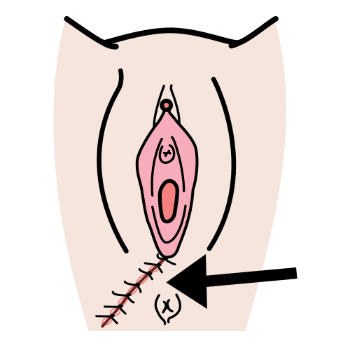 episiotomy