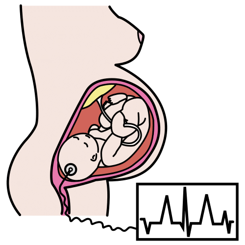 cardiotocografÃ­a interna