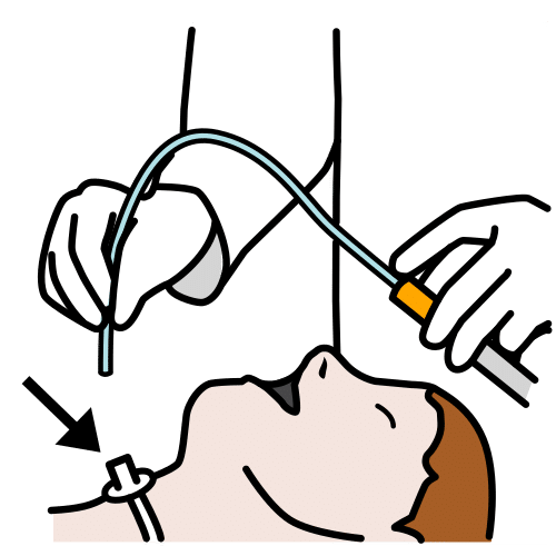 tracheotomy