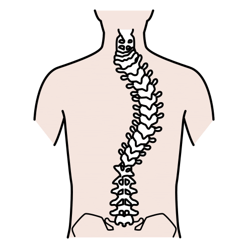 scoliosis