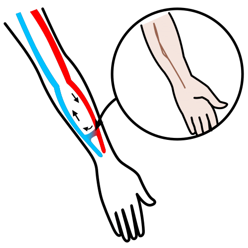 arteriovenous fistula