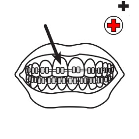 tandbøjler