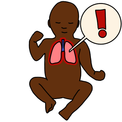 congenital lung malformation