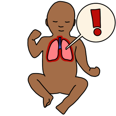 congenital lung malformation