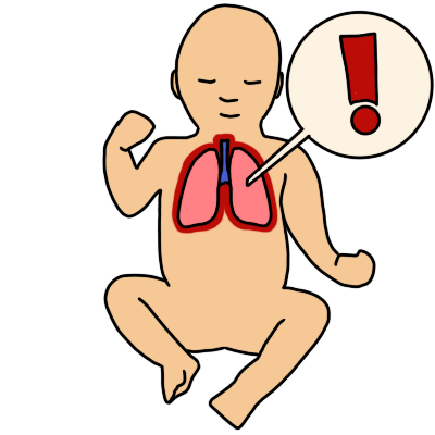 congenital lung malformation