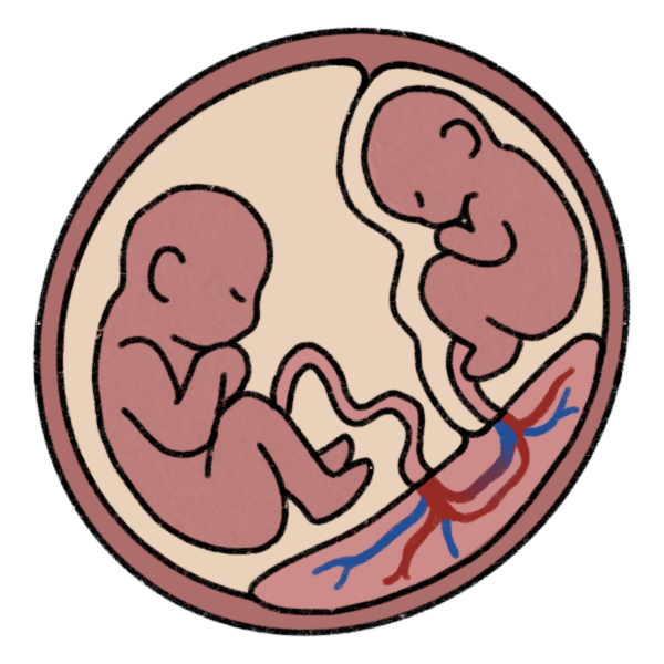 twin to twin transfusion syndrome