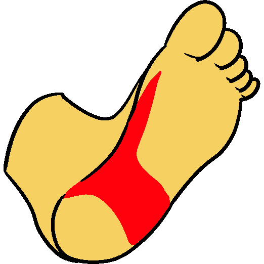 plantar fasciitis