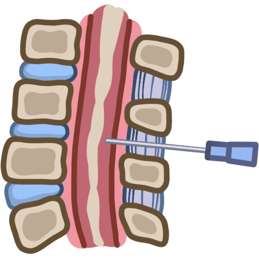 lumbar puncture