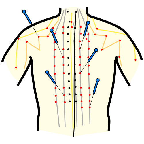 acupuncture