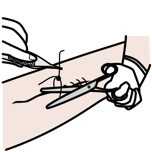 quitar puntos de sutura