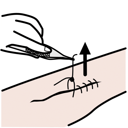 quitar puntos de sutura