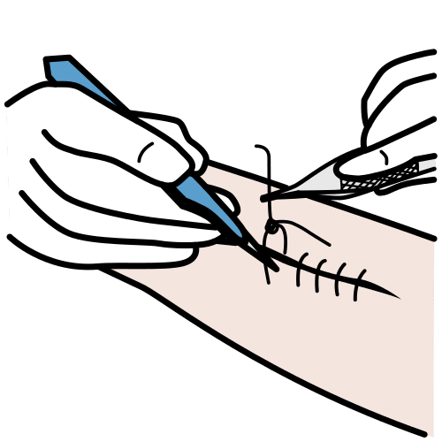 quitar puntos de sutura