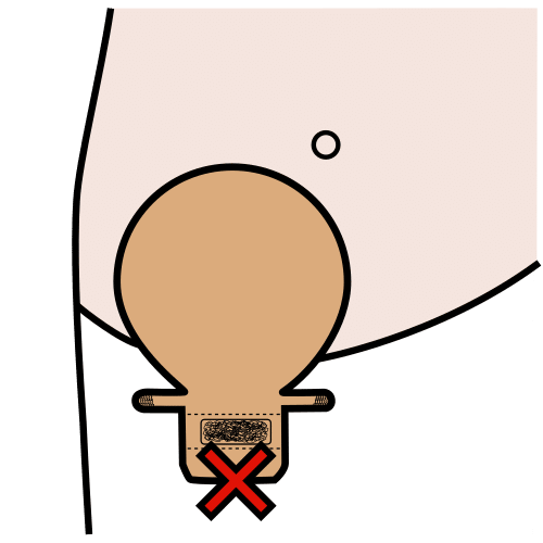 constipation by ostomy