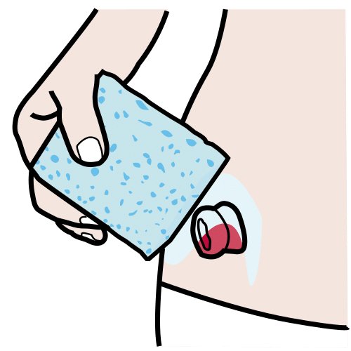 clean the stoma