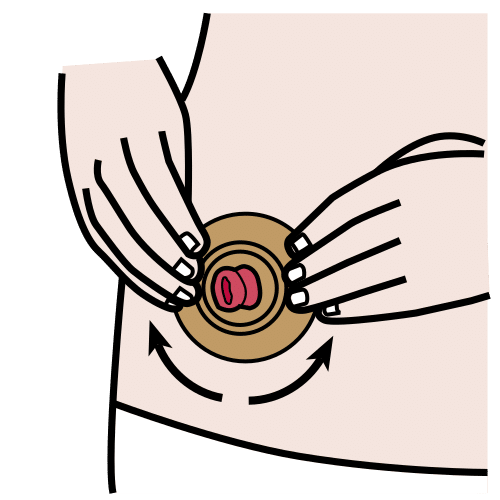 colocar disco de ostomía