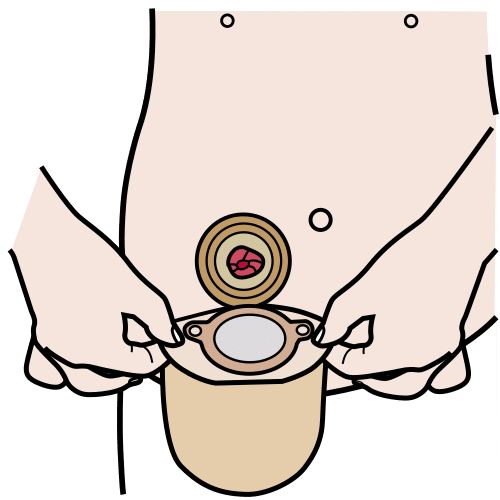 colocar bolsa de ostomía