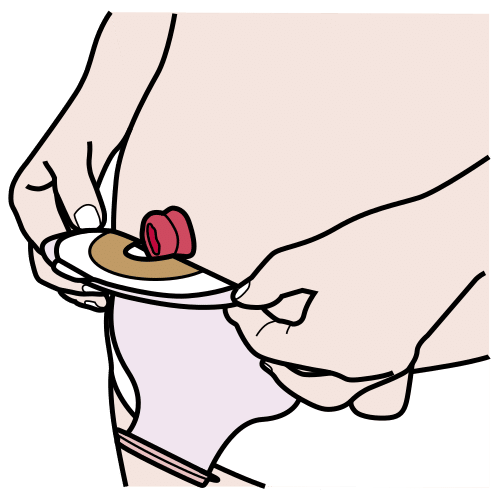 take off ostomy bag