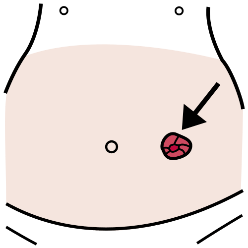 ostomía