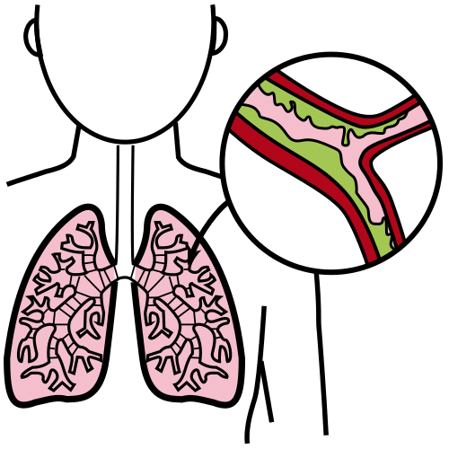 bronchitis