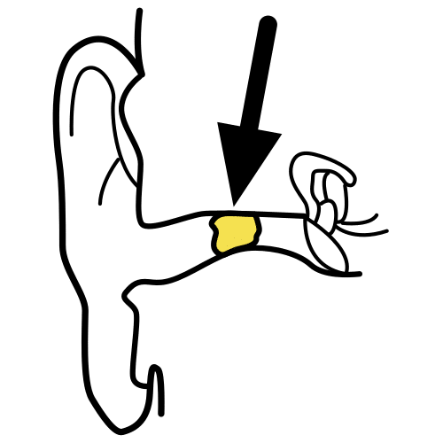 earwax blockage