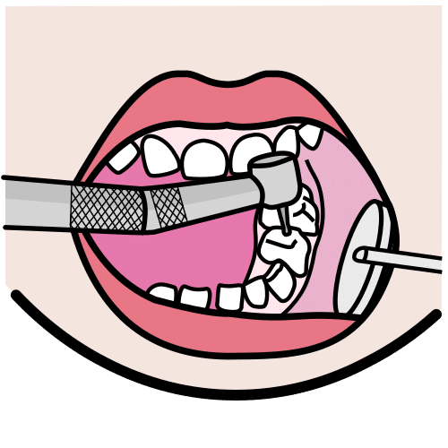 dental cleaning