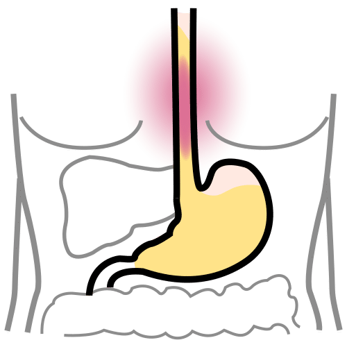 esophageal heartburn