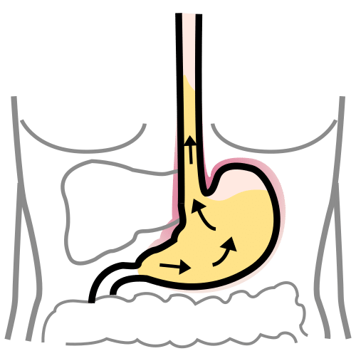 gastroesophageal reflux