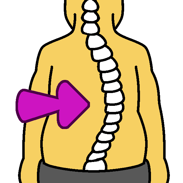 levoscoliosis