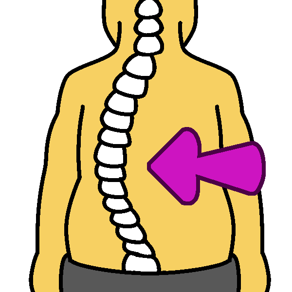 dextroscoliosis