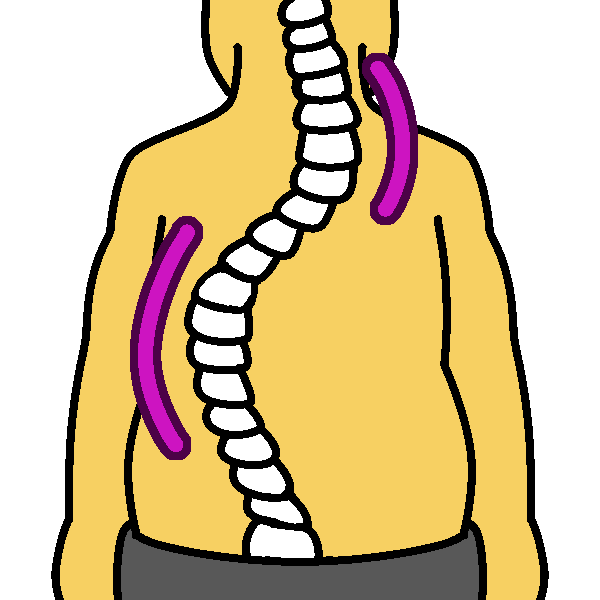 compensatory curve (scoliosis)