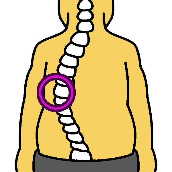 apex (scoliosis)