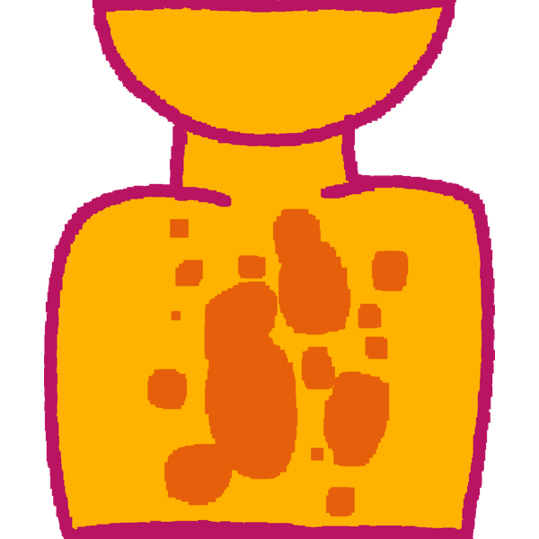 tinea versicolor