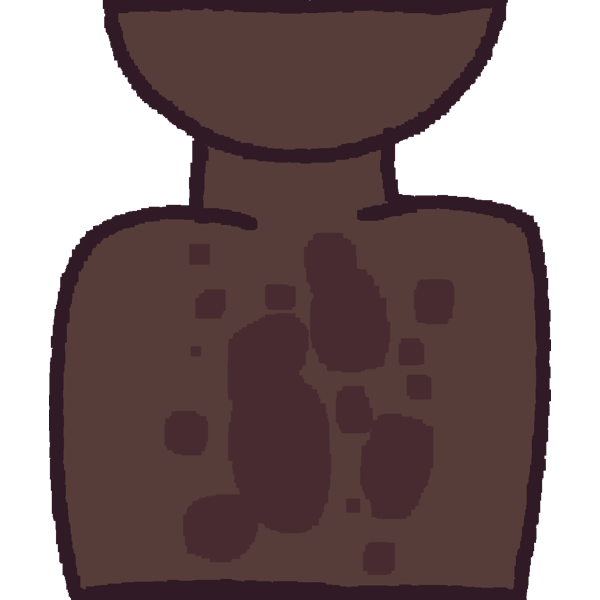 tinea versicolor