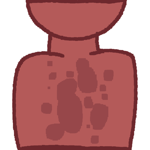 tinea versicolor