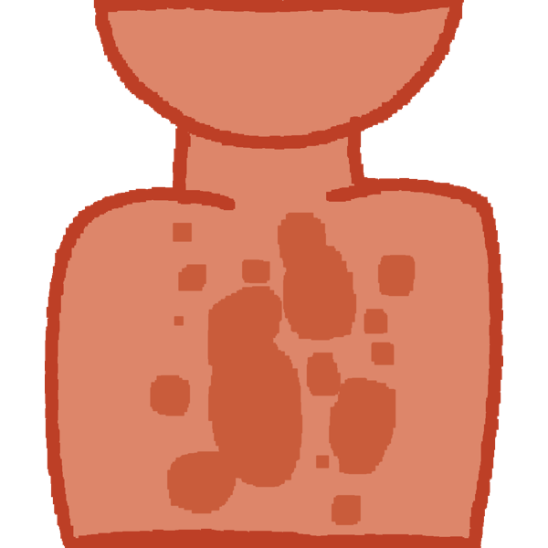 tinea versicolor