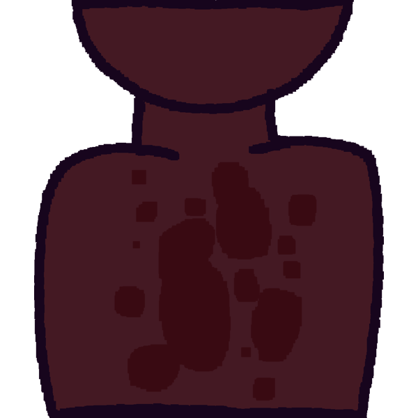 tinea versicolor