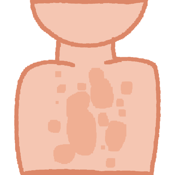 tinea versicolor